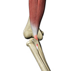 Picture of  Biceps Tendon Repair