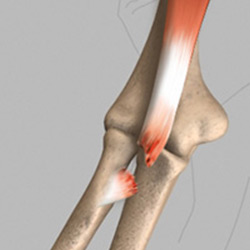 Picture of Biceps Tendon