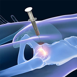 Picture of Bone Marrow Aspirate Concentrate (BMAC) Treatment