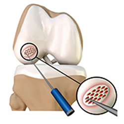Picture of Cartilage Microfracture