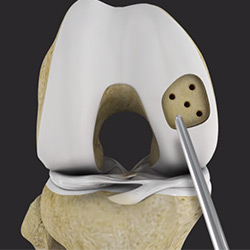 Picture of Cartilage Preservation Techniques