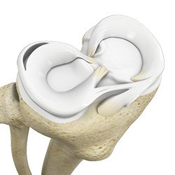 Picture of Degenerative Meniscal Tears