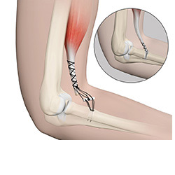 Picture of Distal Biceps Injuries