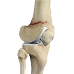 Picture of Distal Femur Fracture