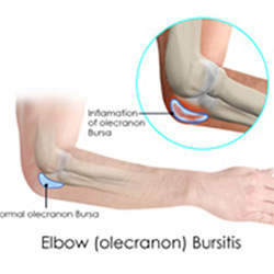 Picture of Elbow Bursitis