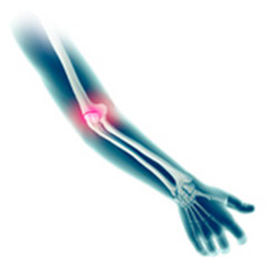 Picture of Elbow (Olecranon) Fractures