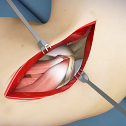 Picture of Elbow Surgery