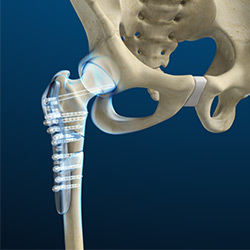 Picture of Fracture Surgery