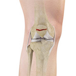 Picture of Fracture of the Patella