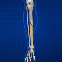 Picture of Fracture of the Tibia