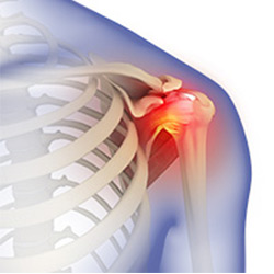 Picture of Frozen Shoulder