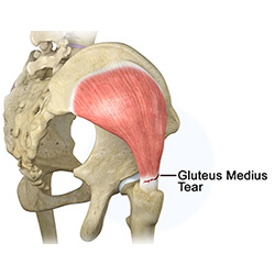 Picture of Gluteus Medius Tear