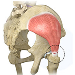 Picture of Gluteus Tendon Tear