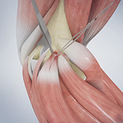 Picture of Golfer's Elbow Surgery 