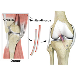 Picture of Hamstring Allograft