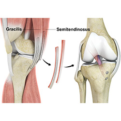 Picture of Hamstring Autograft