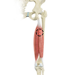 Picture of Hamstring Injuries