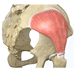 Picture of Hip Adductor Injuries