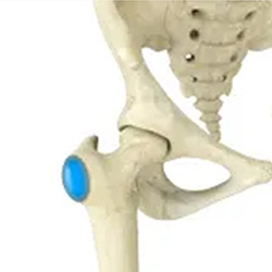 Picture of Hip Bursitis