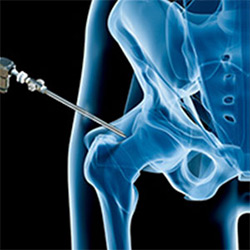 Picture of Hip Injury