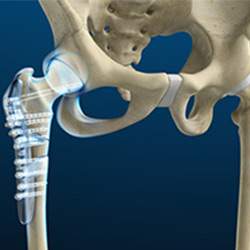 Picture of Hip Surgery