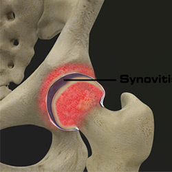 Picture of Hip Synovitis