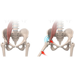 Picture of Iliopsoas Impingement