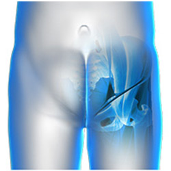 Picture of Iliopsoas Tendonitis