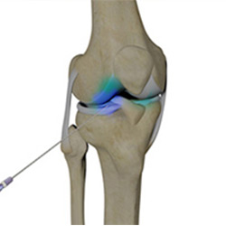 Picture of Intra-articular Knee Injection