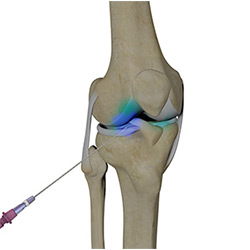 Picture of Intra-Articular Joint Injection
