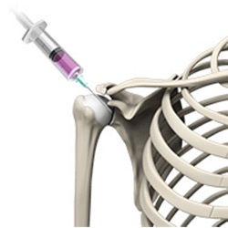 Picture of Intraarticular Shoulder Injection