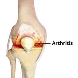 Picture of Knee Arthritis