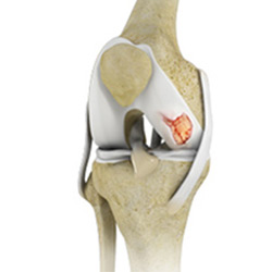 Picture of Knee Cartilage Restoration