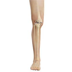 Picture of Knee Dislocation