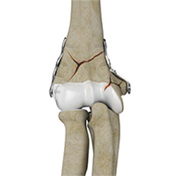 Picture of Knee Fracture