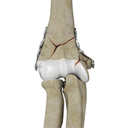 Picture of Knee Fracture Surgery