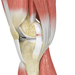 Picture of Knee Ligament Injuries