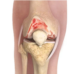 Picture of Knee Osteoarthritis