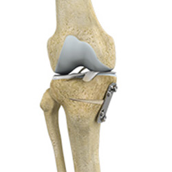 Picture of Knee Osteotomy