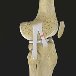 Picture of Knee Sprain