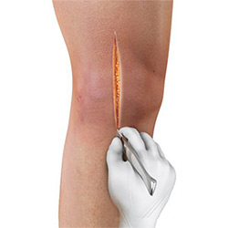 Picture of Knee Surgery