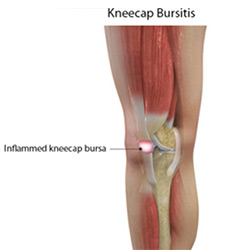 Picture of Kneecap Bursitis