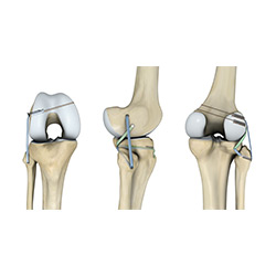 Picture of Ligament Preservation