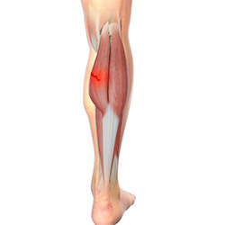 Picture of Medial Gastrocnemius Strain