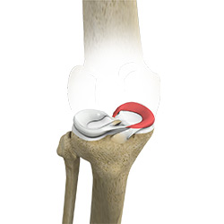Picture of Medial Meniscus Syndrome