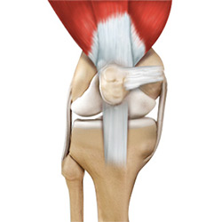 Picture of Medial Patellar Instability