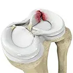 Picture of Meniscal Tears