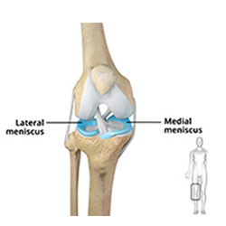 Picture of Meniscectomy