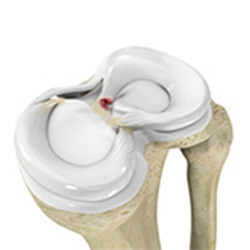 Picture of Meniscus Root Repair