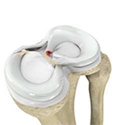 Picture of Meniscus Root Tear